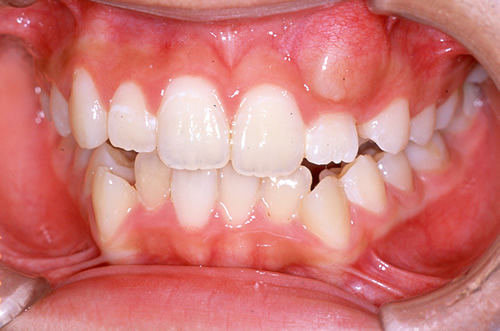 デコボコの歯並びの治療例