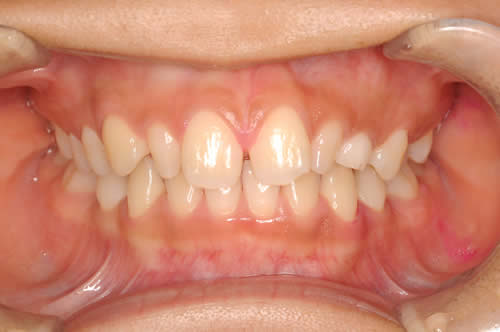前歯の隙間の治療例