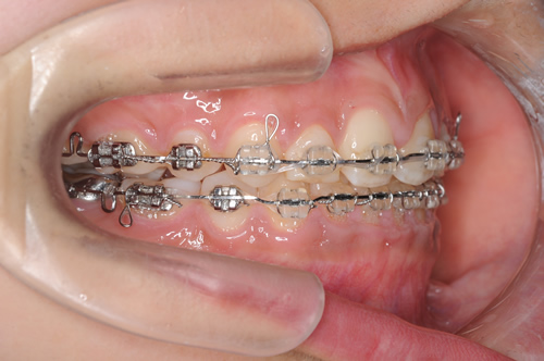 すきっ歯の症例